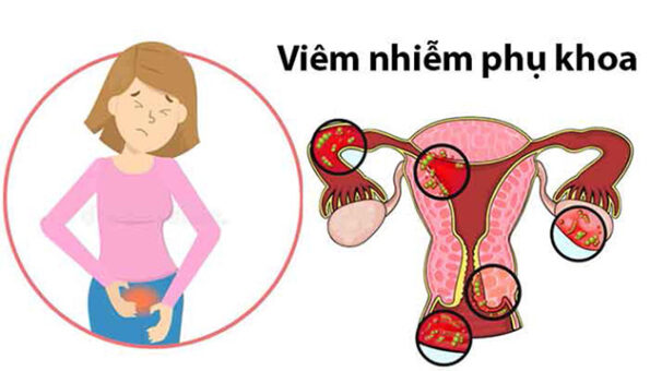 Viêm nhiễm phụ khoa là gì?